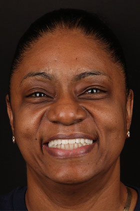 Wide and happy smile after successful gum contouring with porcelain veneers.